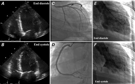 left ventricular hypokinesia.